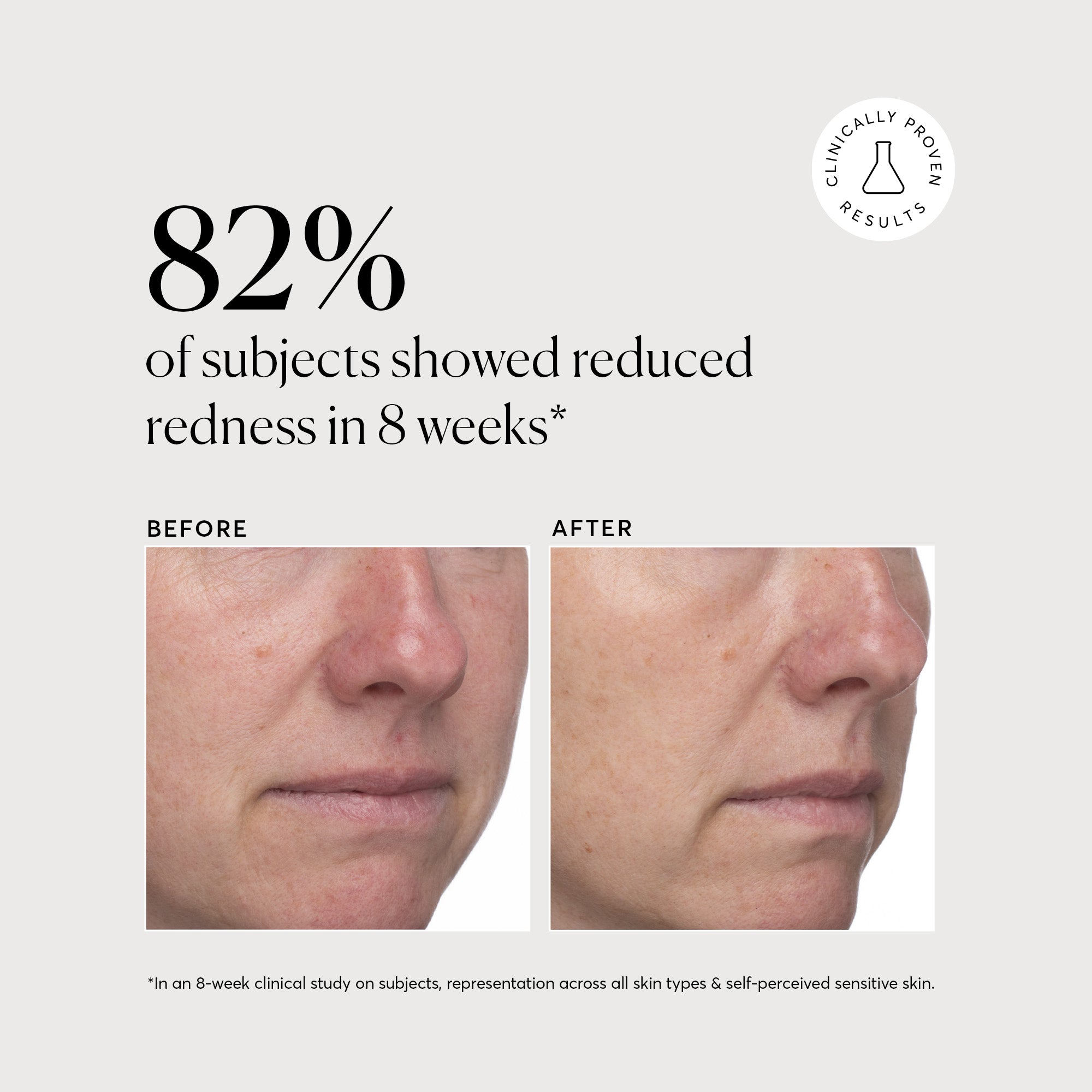 NATR_Azelaic_Acid_Clinical_Redness_B_A_Graphic_Bone